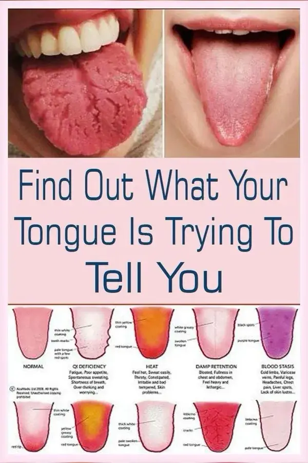 Check ur tongue