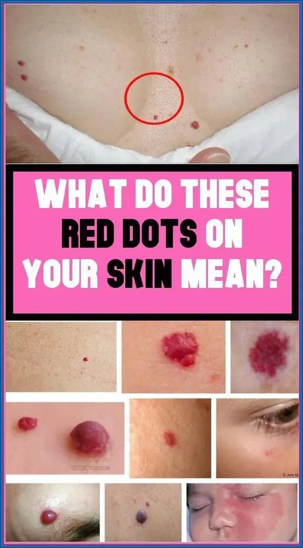 What Do The Red Moles On The Body Mean?