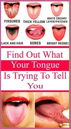 What Your Tongue is Trying to Tell You About Your Health
