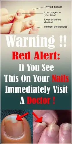 Red Alert: If You See This On Your Nails Immediately Visit A Doctor!