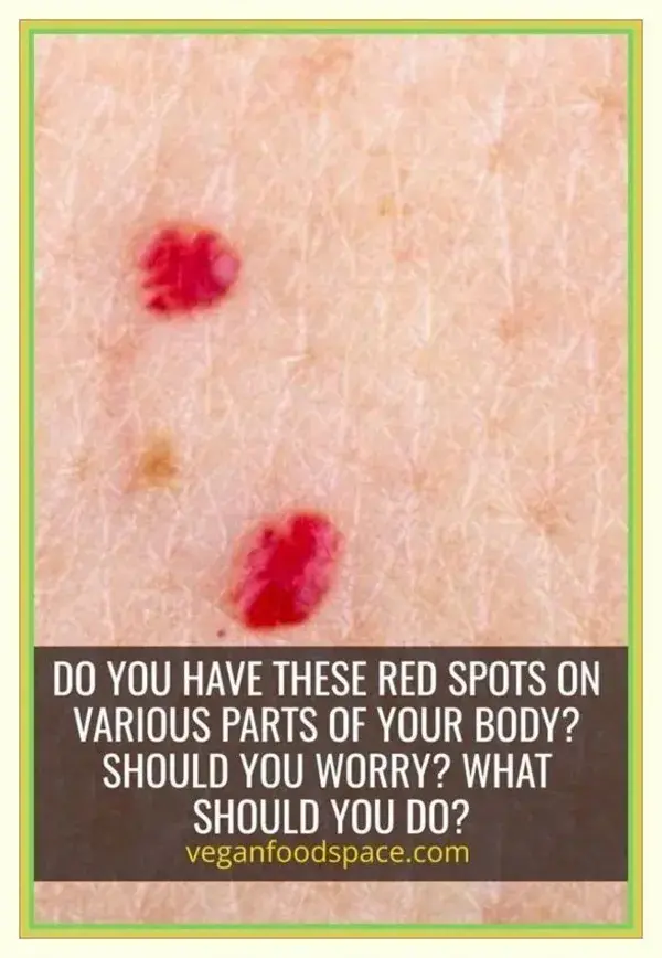 Do You Have These Red Spots On Various Parts Of Your Body!!!