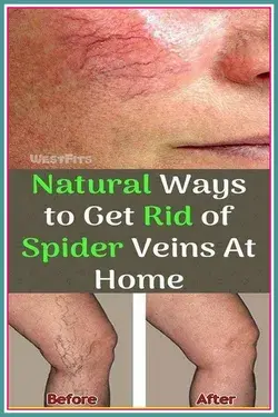 The Best Natural Methods to Get Rid of Spider Veins