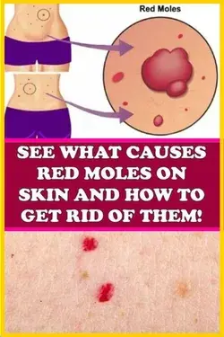 Do You Have These Red Spots on Various Parts of Your Body? Should You Worry? What Should You Do?