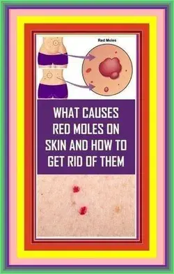 What Do The Red Moles On The Body Mean?