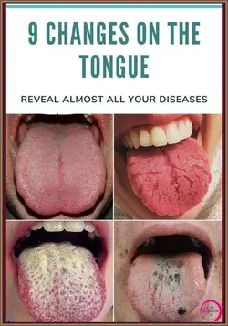 Be Aware Of THIS: These 9 Changes On Your Tongue Reveal Almost All Your Diseases