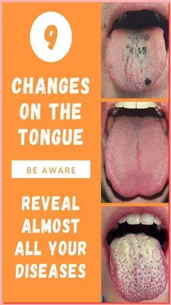 TAKE A CLOSER LOOK, THE COLOR OF YOUR TONGUE CAN REVEAL IF YOU HAVE CANCER