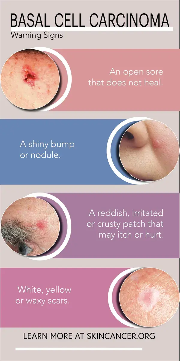 Basal Cell Carcinoma Warning Signs