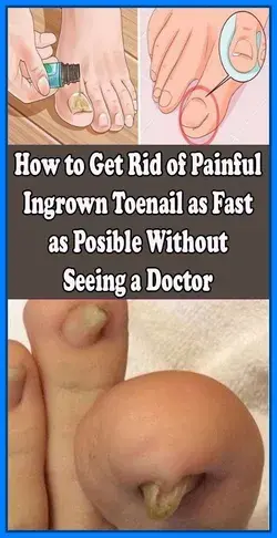 Best and Easy ways to get rid of Toenail Fungus-Real Cause of Fungus infection