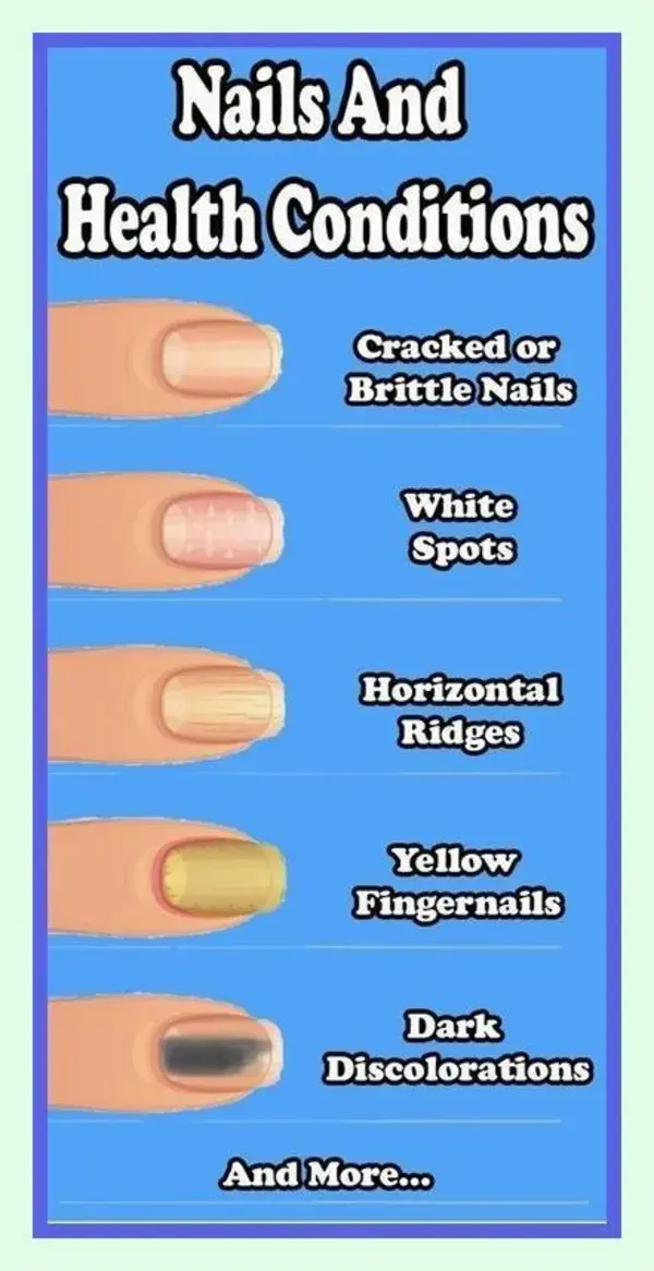 8 Important Signs Your Fingernails Can Tell About Your Health