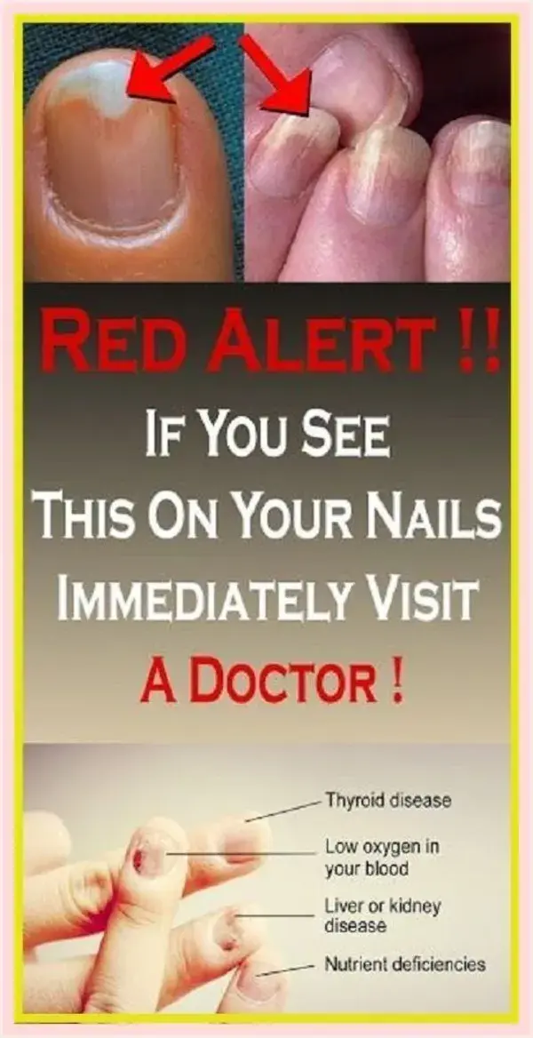 Red Alert: If You See This On Your Nails Immediately Visit A Doctor!