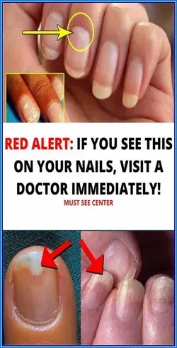 Red Alert: If You See This On Your Nails Immediately Visit A Doctor!