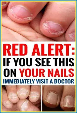 Red Alert - If You See This on Your Nails Immediately Visit a Doctor!