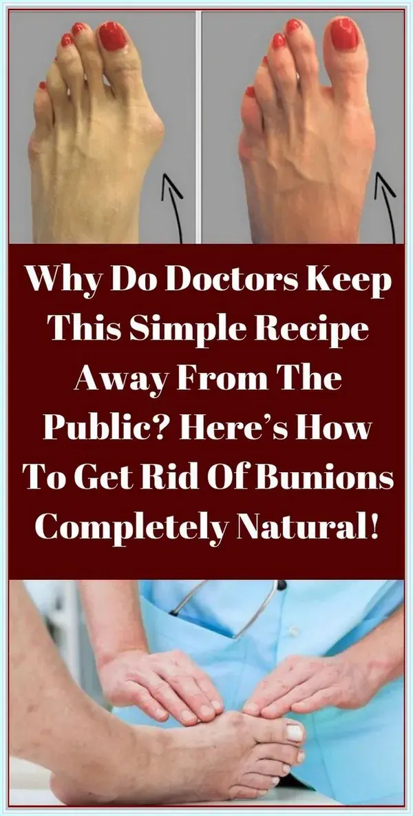 WHY DO DOCTORS KEEP THIS SIMPLE RECIPE AWAY FROM THE PUBLIC? HERE�S HOW TO GET RID OF BUNIONS