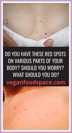 Do You Have These Red Spots On Various Parts Of Your Body