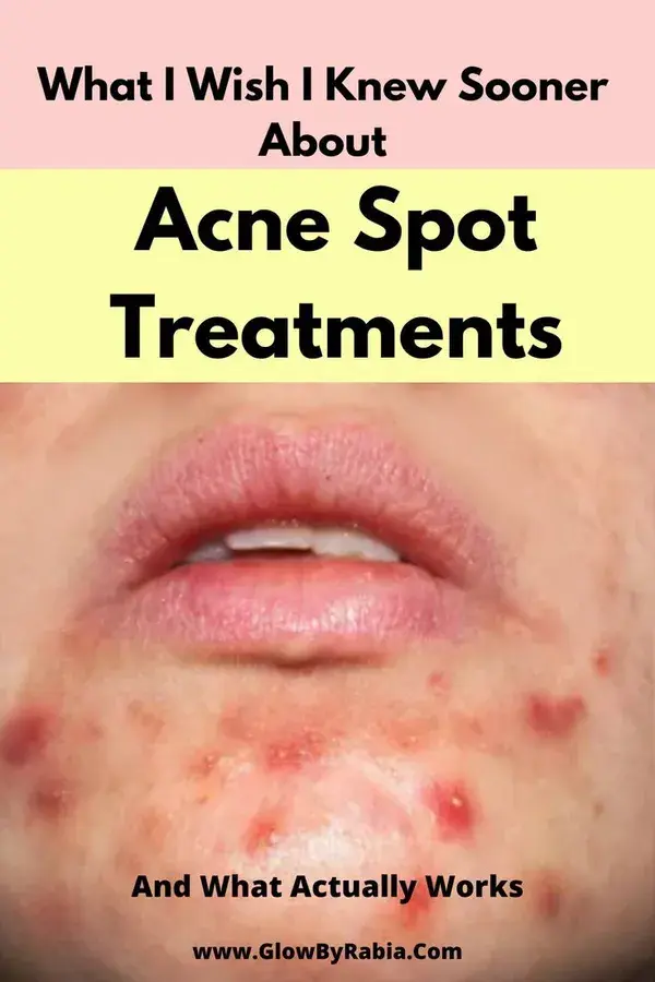 How To Get Rid Of Acne Spots The Right Way