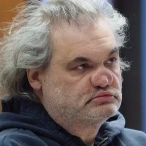 Artie Lange / Collasped  nose due to cocaine abuse