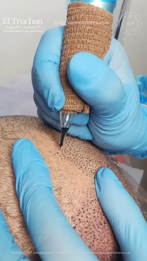 So, does scalp micropigmentation look fake?