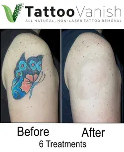 www.tattoovanishmethod.com