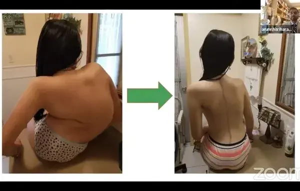 Neuromuscular scoliosis