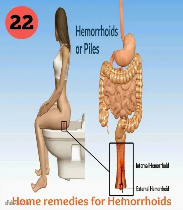 Cure your hemorrhoids in 24 hours with this single kitchen ingredient.