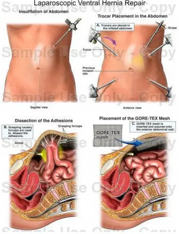 Laparoscopic ventral hernia repair