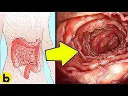 5 Home Remedies For Natural Colon Cleansing - YouTube