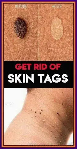 HOW TO REMOVE SKIN TAG IN 1 NIGHT