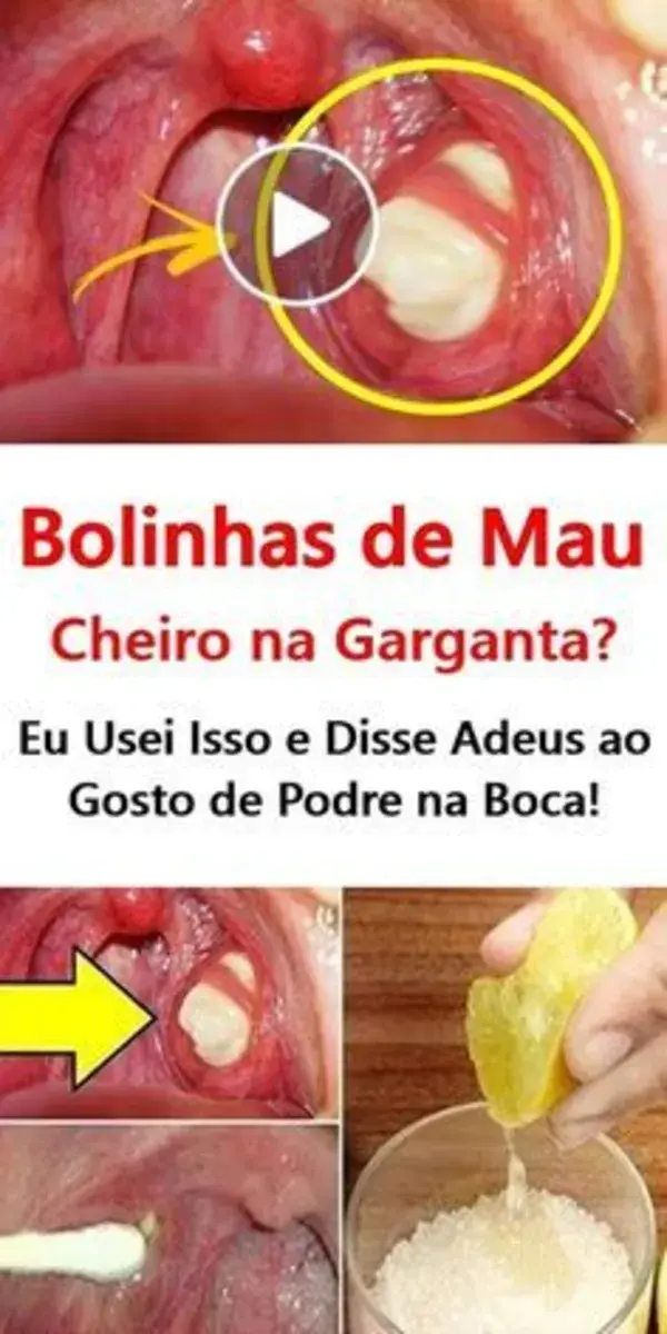 Como Curar a Amigdalite de Forma Rápida e Com Receitas Naturais!