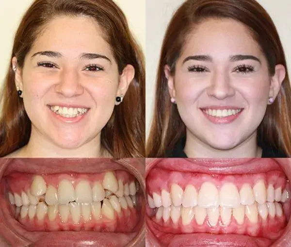 www.laredobraces.com