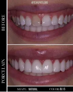 Veneer before and after