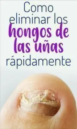 ¿Cómo curar las uñas que sufren de hongos?