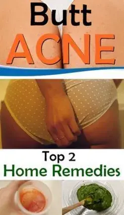 8 Ways To Get Rid Of Butt Acne ASAP