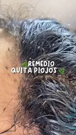 remedios naturales para eliminar los piojos