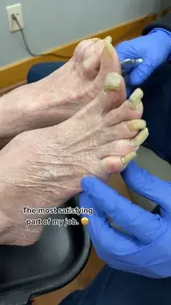 Fungal Nail Infection (Onychomycosis)