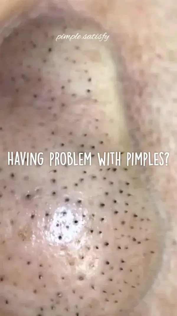 Having problem with pimples?