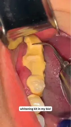 Tartar removal