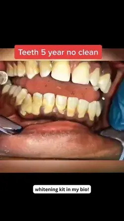 Teeth cleaning after 5 years