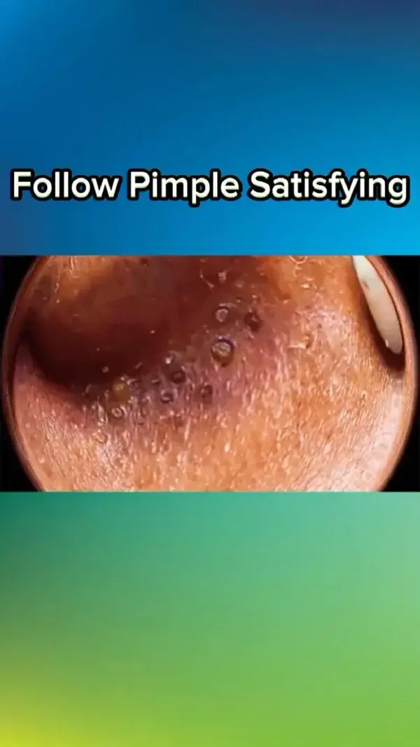 #satisfyingvideo #acne #pimple #asmar #PimplePopping #pimplesremover #cleaning #blackheadremoval