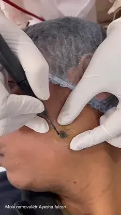 Mole Removal