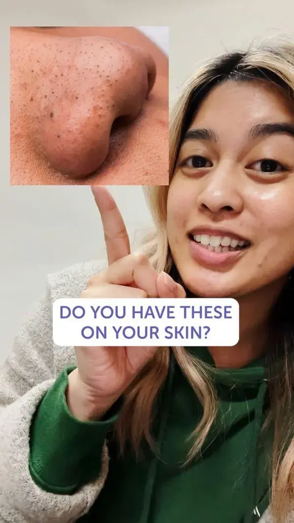 Do you Have Blackheads on your Nose?