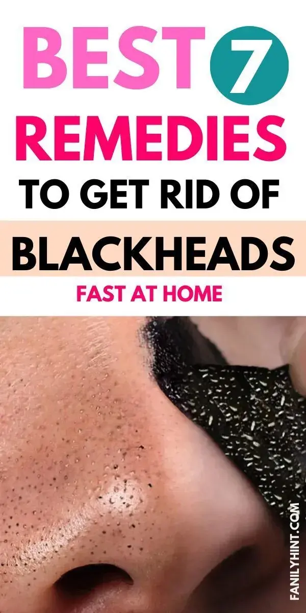 How to Get Rid of Blackhead | 10 Home Remedies for Blackheads That Actually Work