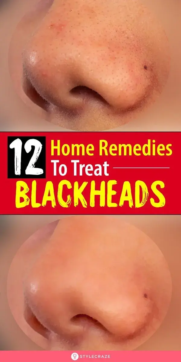 12 Home Remedies To Treat Blackheads