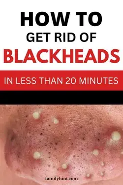 How to Remove Blackheads on Nose at Home - 5 Home Remedies for Blackheads