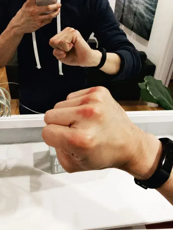 Bruised knuckles