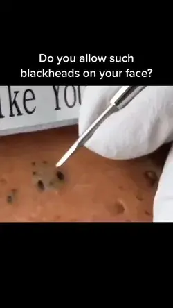 If you don’t want to have big blackheads, you have to eliminate them as soon as possible.