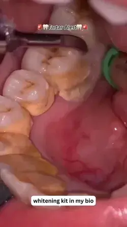 Tartar buildup on teeth