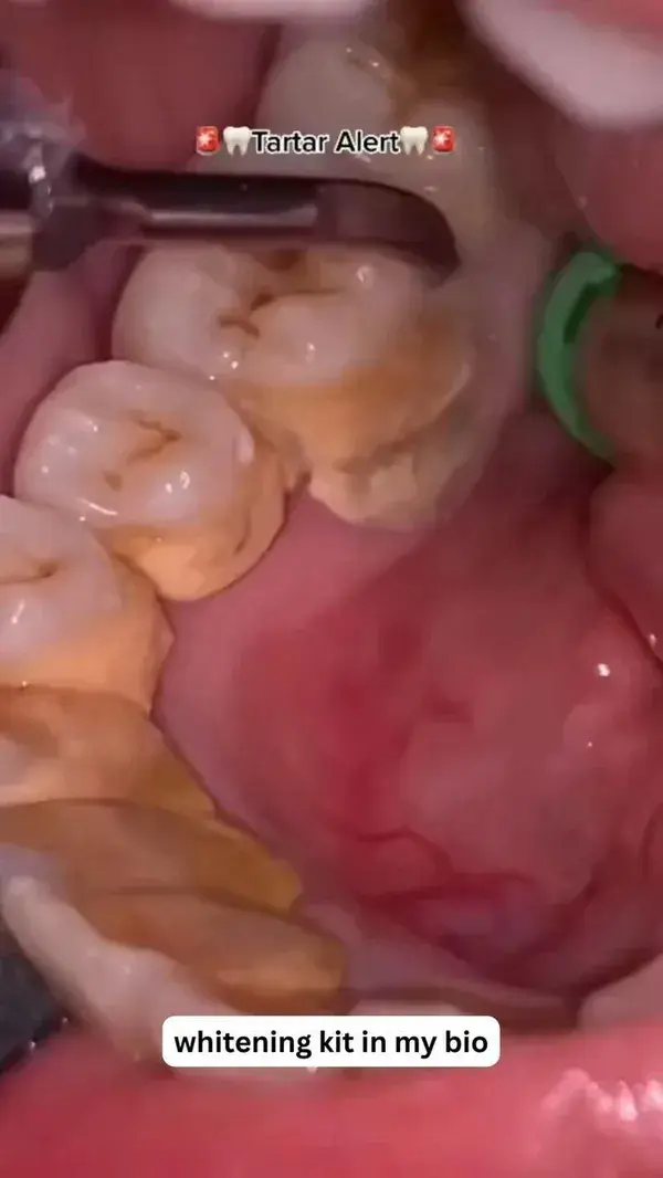 Tartar buildup on teeth