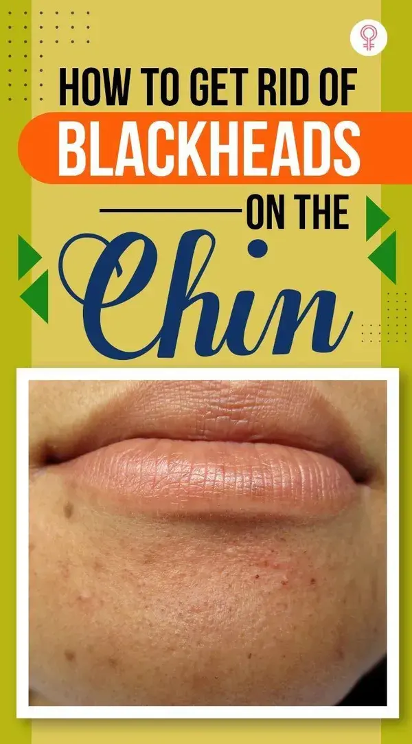 How To Get Rid Of Blackheads On The Chin