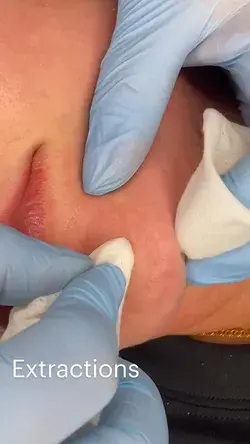 Extractions! How satisfying are they ������������������������