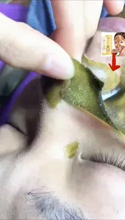Black head removing satisfying video with Honey mask 💥